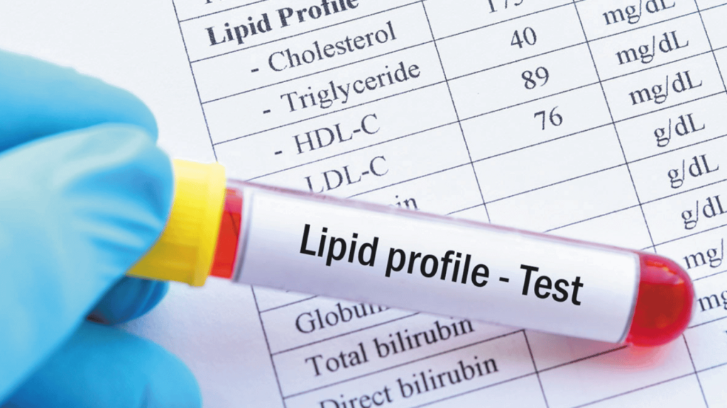 Lipid Profile Test